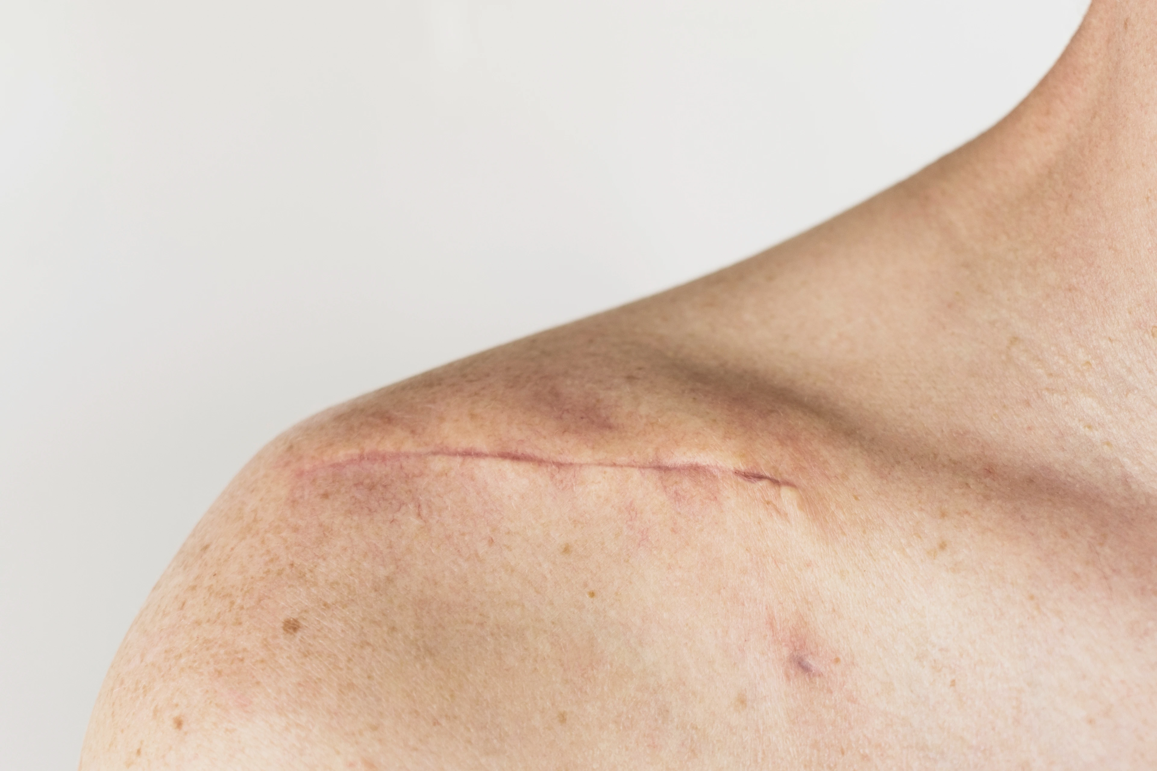 scar on the of a male body after surgery on a broken collarbone, acromion and shoulder