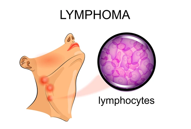 swollen lymph nodes in lymphoma. Oncology