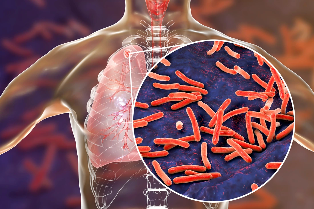 Tuberkulose in der Lunge und Nahaufnahme von Mycobacterium tuberculosis-Bakterien