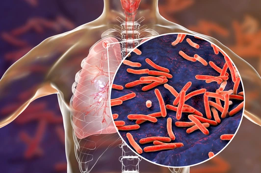Tuberkulose in der Lunge und Nahaufnahme von Mycobacterium tuberculosis-Bakterien
