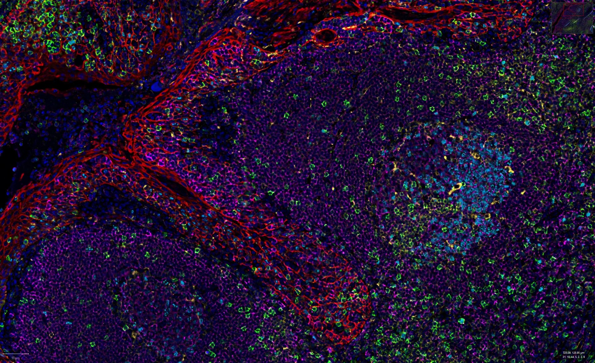 Rodriguez-Calvo_Tonsil