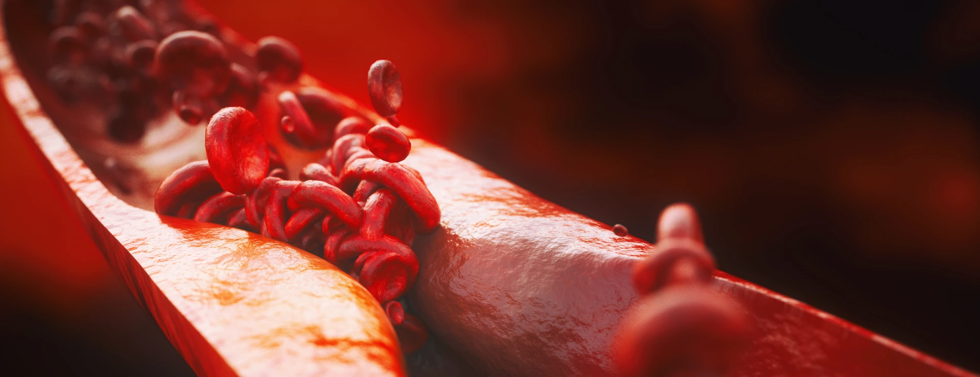 Closeup of a atherosclerosis- 3D rendering