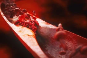 Closeup of a atherosclerosis- 3D rendering