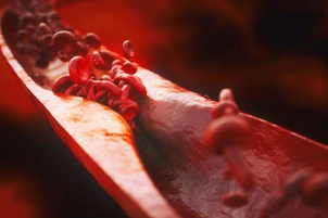 Closeup of a atherosclerosis- 3D rendering