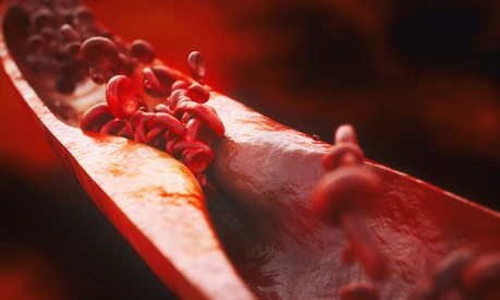 Closeup of a atherosclerosis- 3D rendering