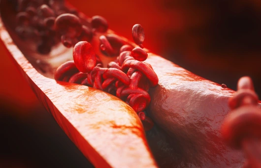Closeup of a atherosclerosis- 3D rendering