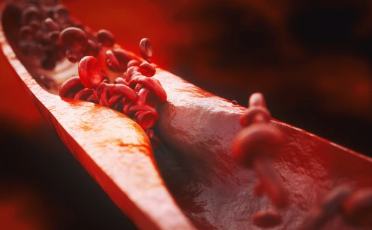 Closeup of a atherosclerosis- 3D rendering