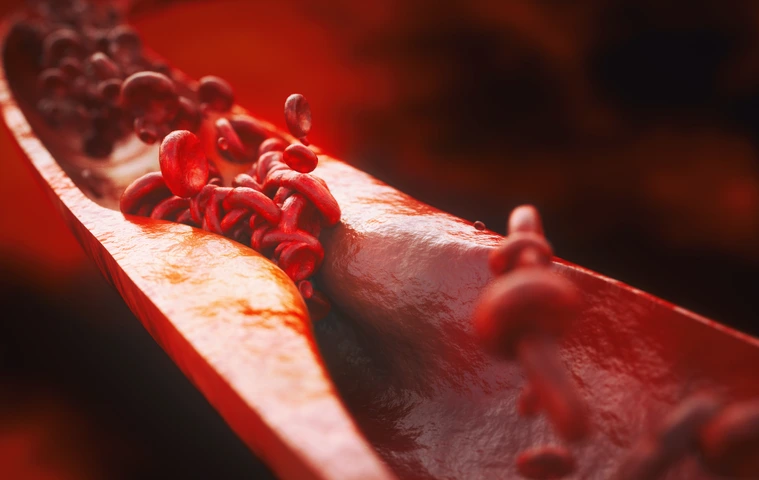 Closeup of a atherosclerosis- 3D rendering