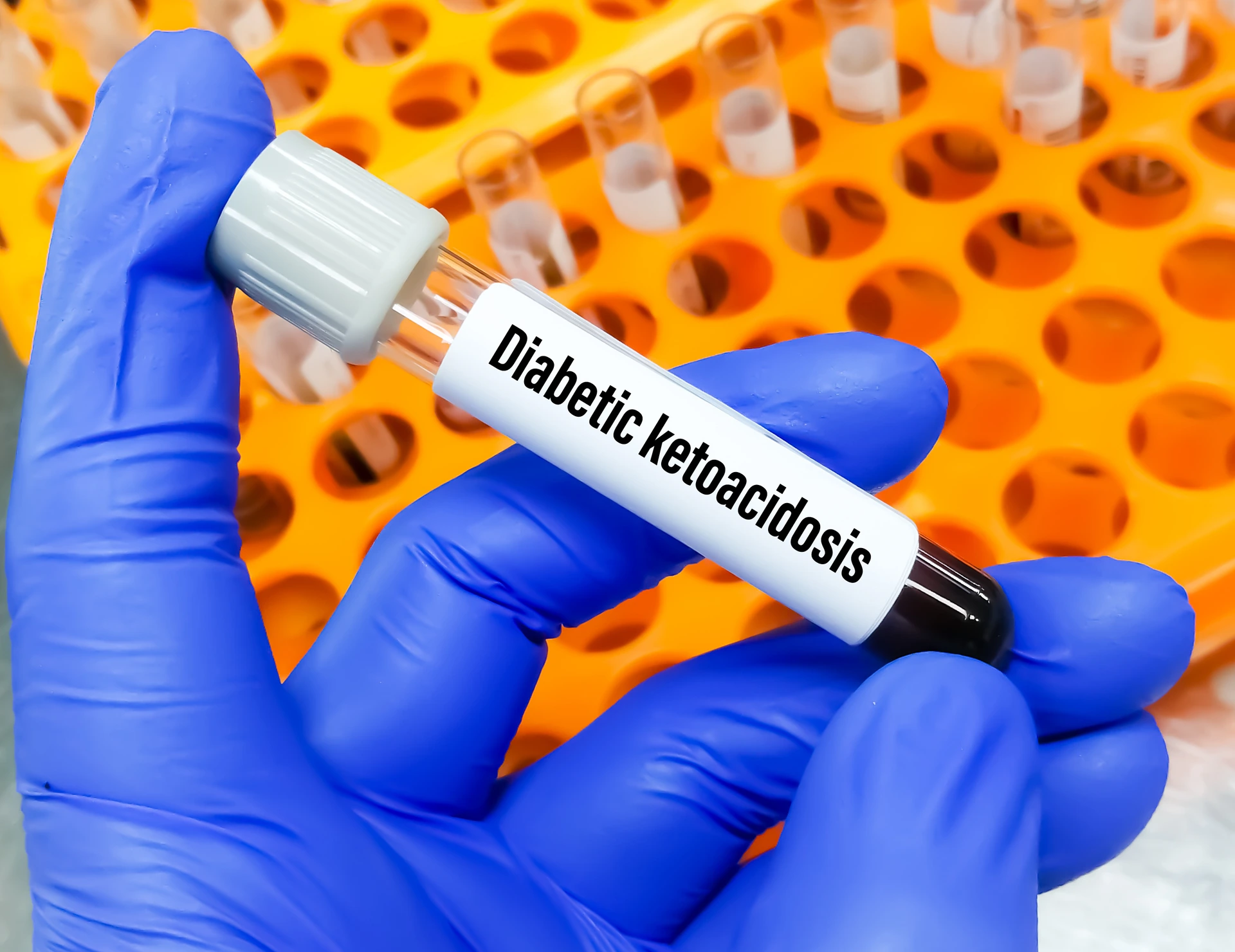 Blutprobe für diabetische Ketoazidose-Test