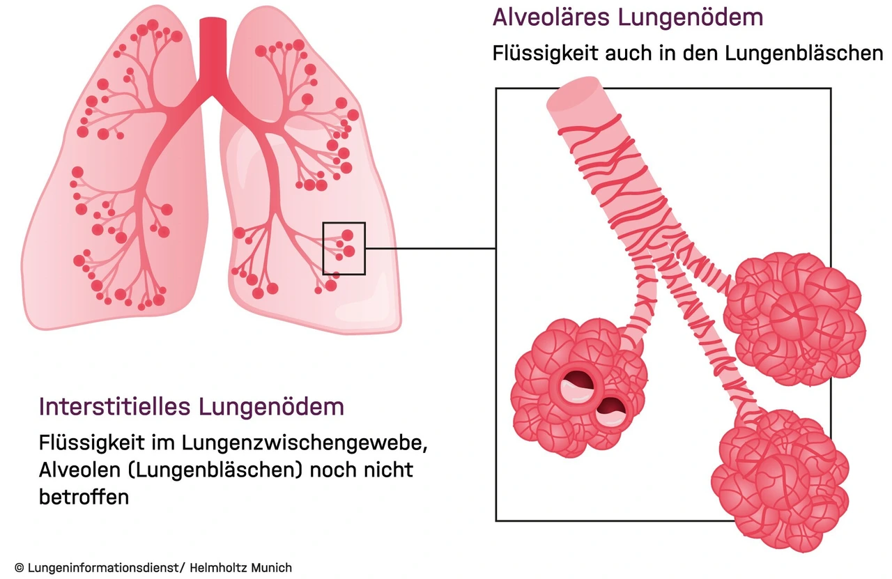 Lungenoedem